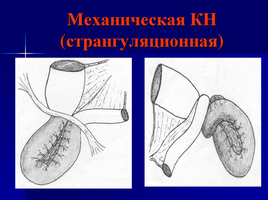 Кишечная непроходимость презентация по хирургии