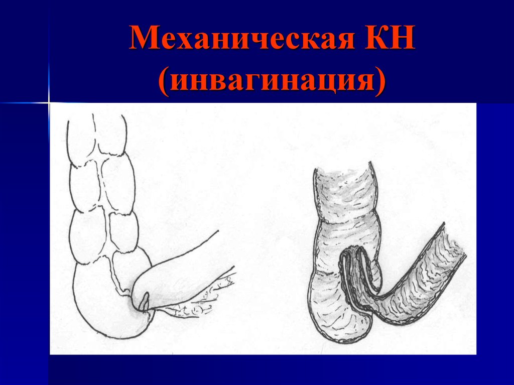 Механическая КН (инвагинация)