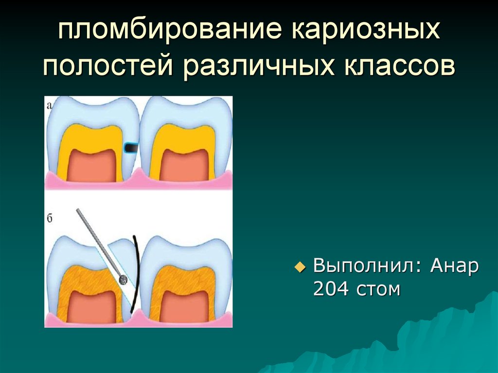 Препарирование полости. Методика туннельного препарирования. Туннельный метод препарирования зубов. Этапы пломбирования кариозных полостей 1 класса. Туннельное препарирование кариозной полости.