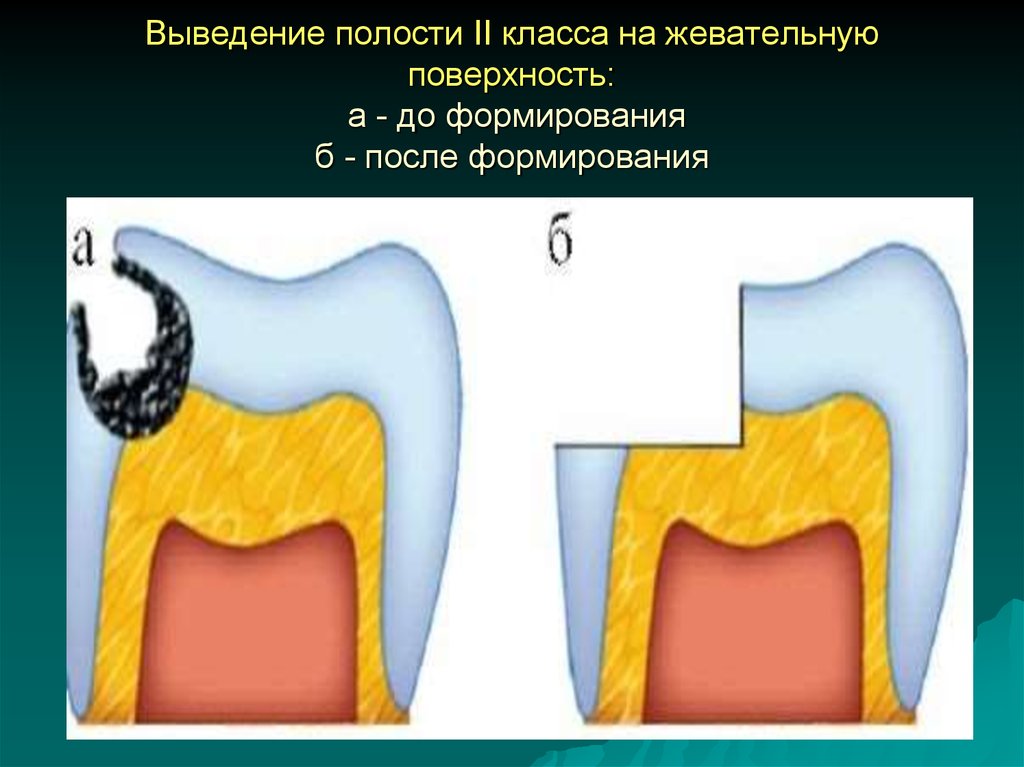 Классы по блэку. Препарирование кариозных полостей 2 класса. Элементы отпрепарированной кариозной полости. Формирование кариозной полости. Этапы формирования кариозной полости.