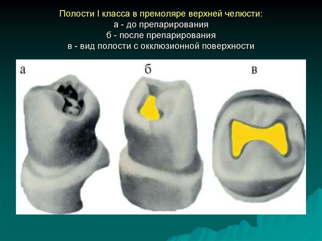 Классификация полостей. Препарирование и пломбирование кариозной полости 2 класс. Кариозная полость 1 класса по Блэку. Препарирование кариозных полостей 1 класса по Блэку. Препарирование по Блэку 1 класс премоляр.