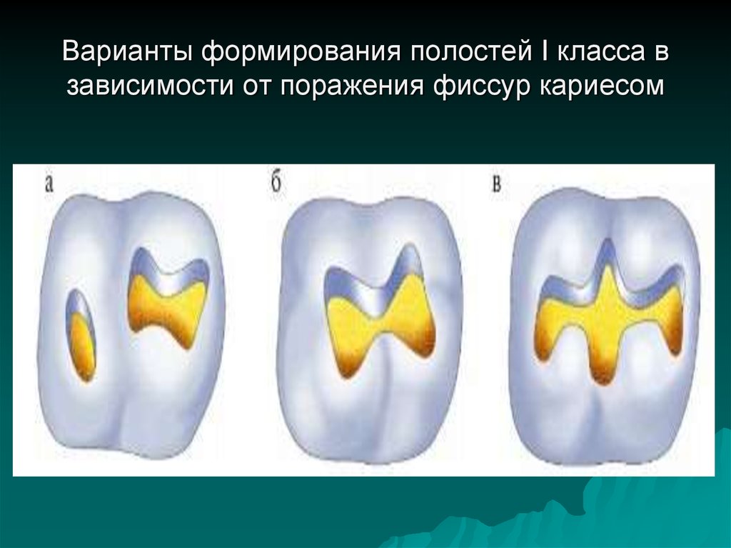 Классы полостей. Кариозная полость 1 класса по Блэку. Варианты кариозных полостей i класса.. Кариозные полости 1 класса по Блеку. Препарирование кариозных полостей 1 класса.