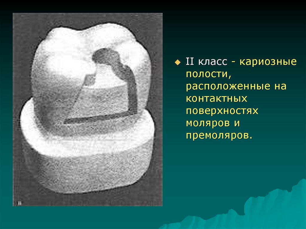 Классы по блэку. Второй класс кариозной полости по Блэку. Препарирование 2 класса по Блэку. Полость 2 класса по Блэку премоляр. Полость по 2 классу Блэка.