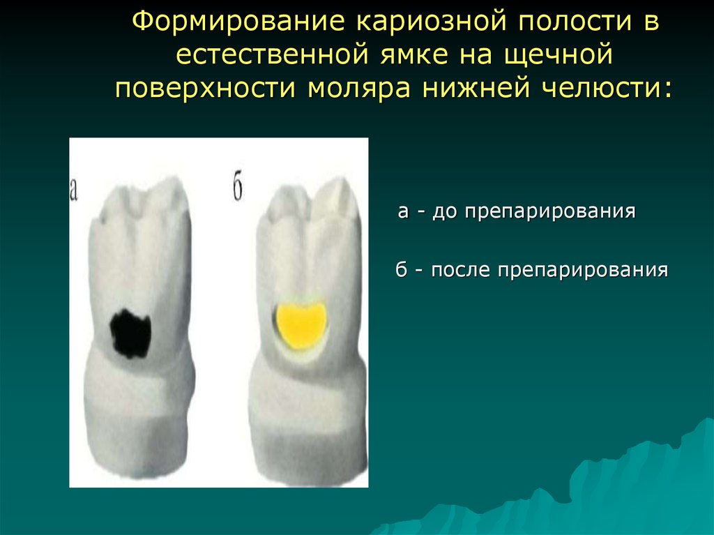 Формирование полости. Формирование полостей по Блэку. Формирование кариозной полост. Формирование кариозных полостей по Блэку. Формирование полости 2 класса по Блэку.