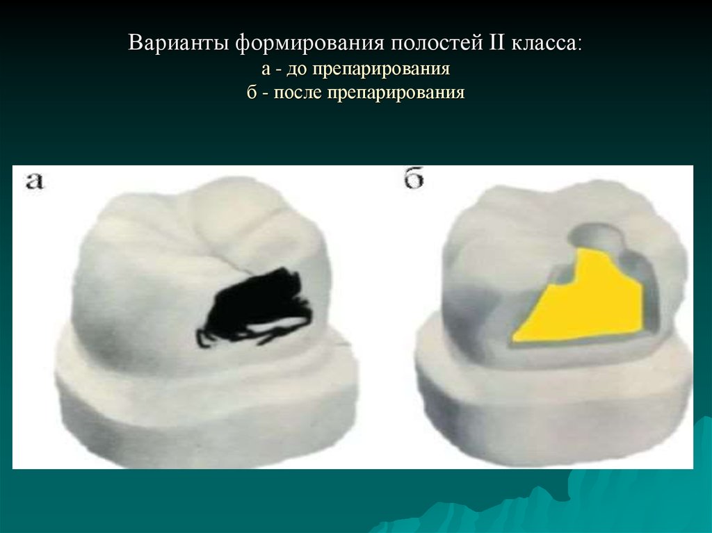 Пломбирование полости. Варианты формирования кариозных полостей 2 класса. Формирование полости кариозной полости 2 класса. Полость 2 класса по Блэку. Формирование полости 2 класса по Блэку.