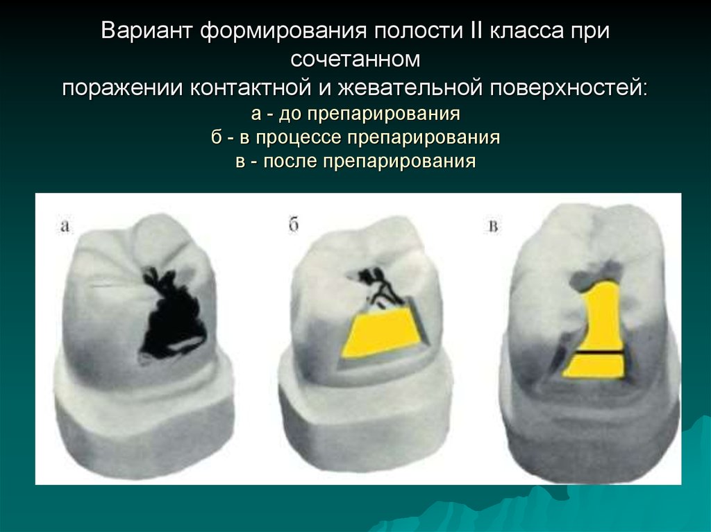 2 полости. Препарирование кариозных полостей 2 класса по Блэку. Варианты формирования кариозных полостей 2 класса. Пломбирование полостей v и III класса. Препарирование и пломбирование полостей v класса.