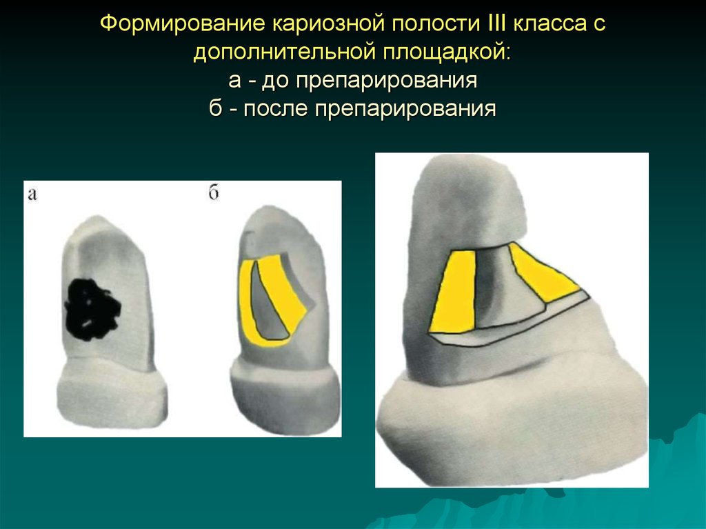 9 полостей. Кариозные полости 2 класса по Блэку. 3 Класс Блэка препарирование кариозных полостей. Препарирование полости третьего класса по Блэку. Препарирование по 3 классу Блэка с дополнительной площадкой.