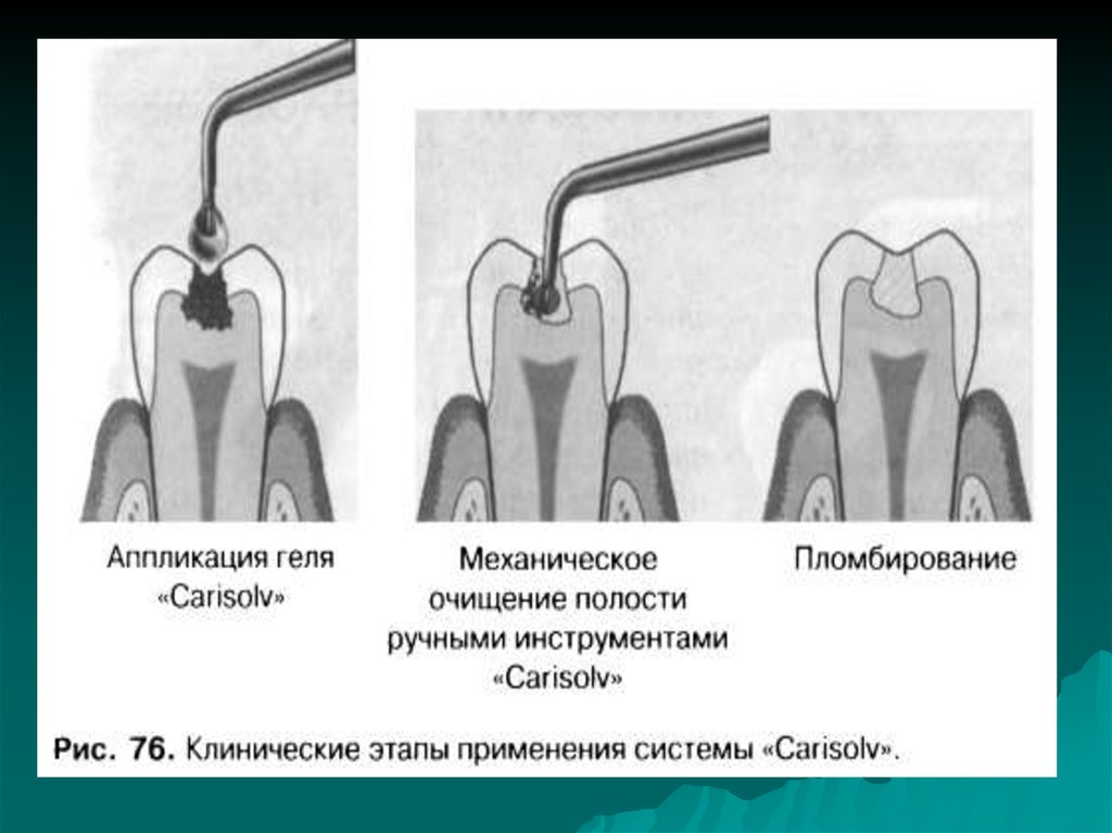 Пломбирование кариозных полостей временных. Пломбирование кариозных полостей 1 класса. Пломбирование полостей 1 класса этапы. Этапы пломбирования кариозных полостей 1 класса. Этапы препарирования кариозных полостей.