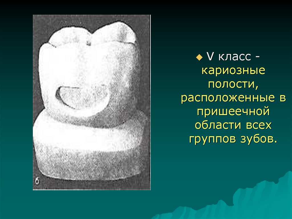 V класс по блэку. Препарирование кариозных полостей. Препарирование и пломбирование полостей v класса. Препарирование полостей 5 класса. Формирование полости 5 класса по Блэку.