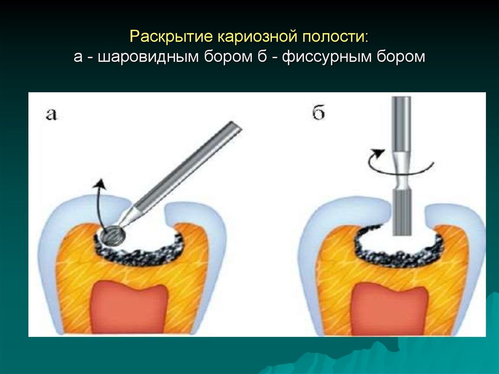 Препарирование кариозной полости 1 класса