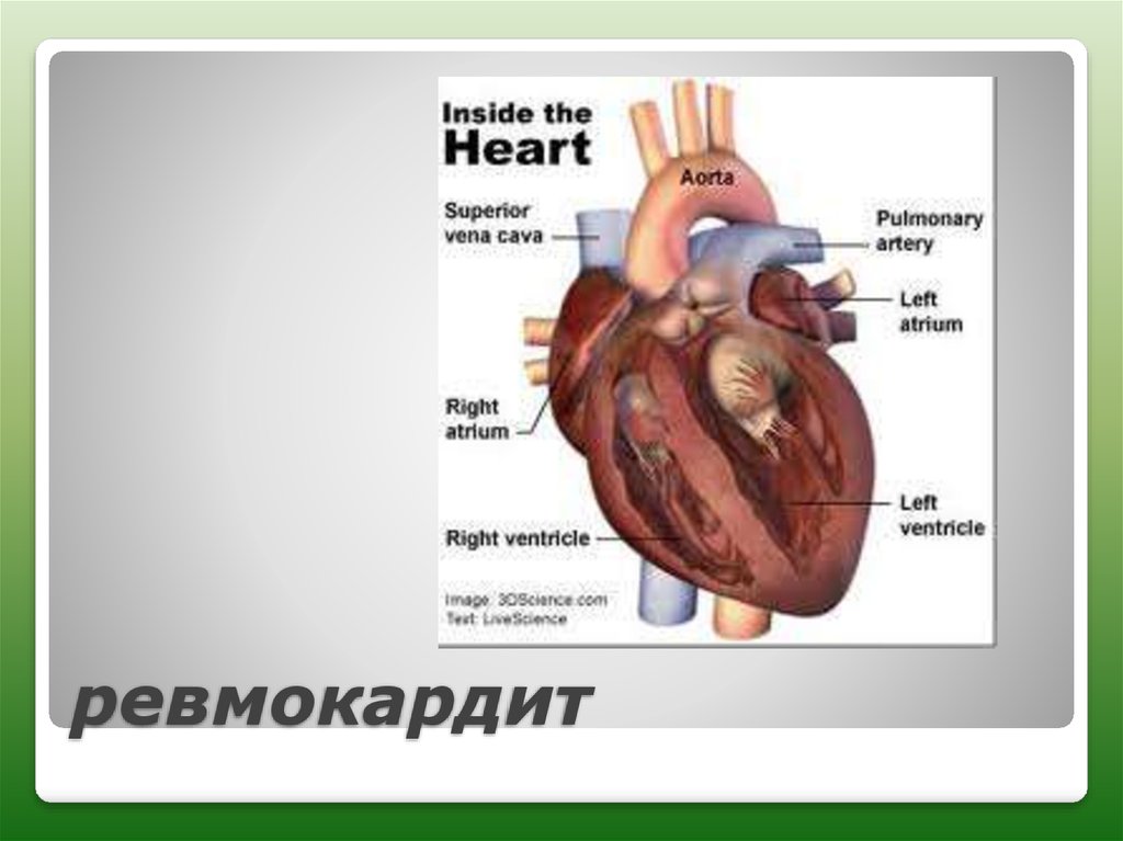 Ревмокардит. Возвратный ревмокардит. Треклятый ревмокардит.