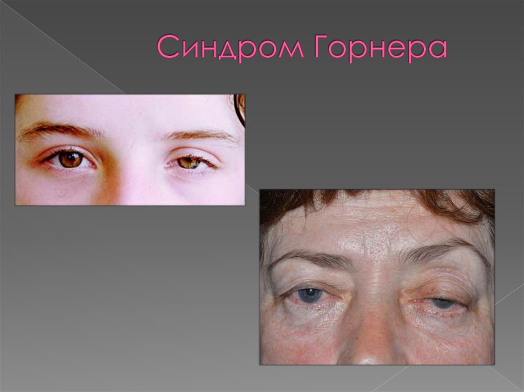 Расслоение аневризмы аорты. Клиника - презентация онлайн