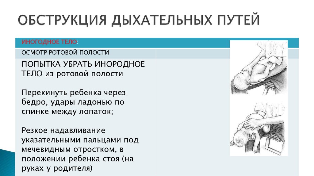 Виды обструкции дыхательных путей схема