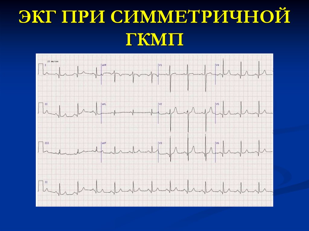 Экг при дилатационной кардиомиопатии фото