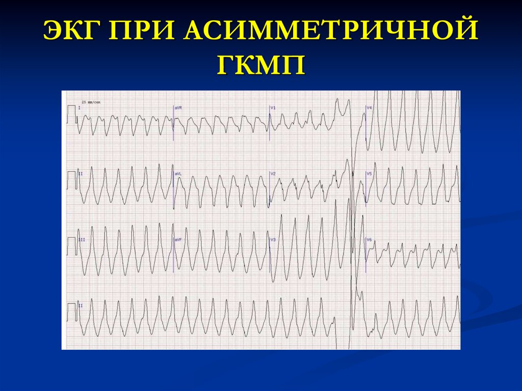 Экг при дилатационной кардиомиопатии фото