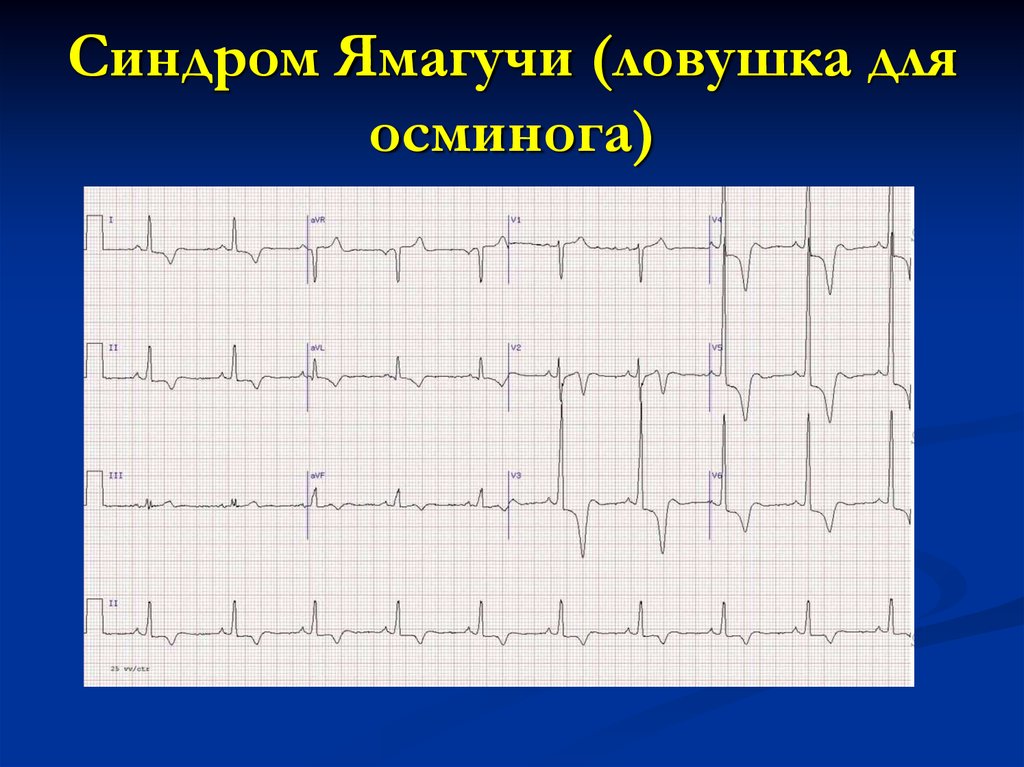 Синдром Ямагучи (ловушка для осминога)