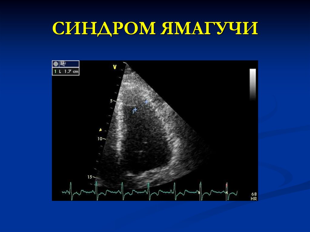 СИНДРОМ ЯМАГУЧИ