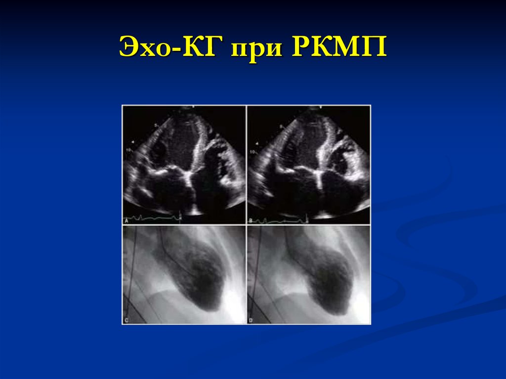 Эх кг. Рестриктивная кардиомиопатия ЭХОКГ. ЭХОКГ при рестриктивной кардиомиопатии. Кардиомиопатия на Эхо. Рестриктивная кардиомиопатия Эхо.