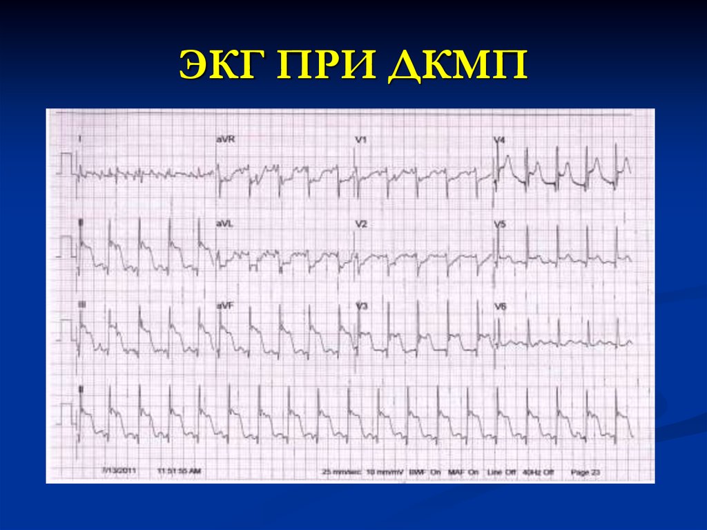 Экг при дилатационной кардиомиопатии фото