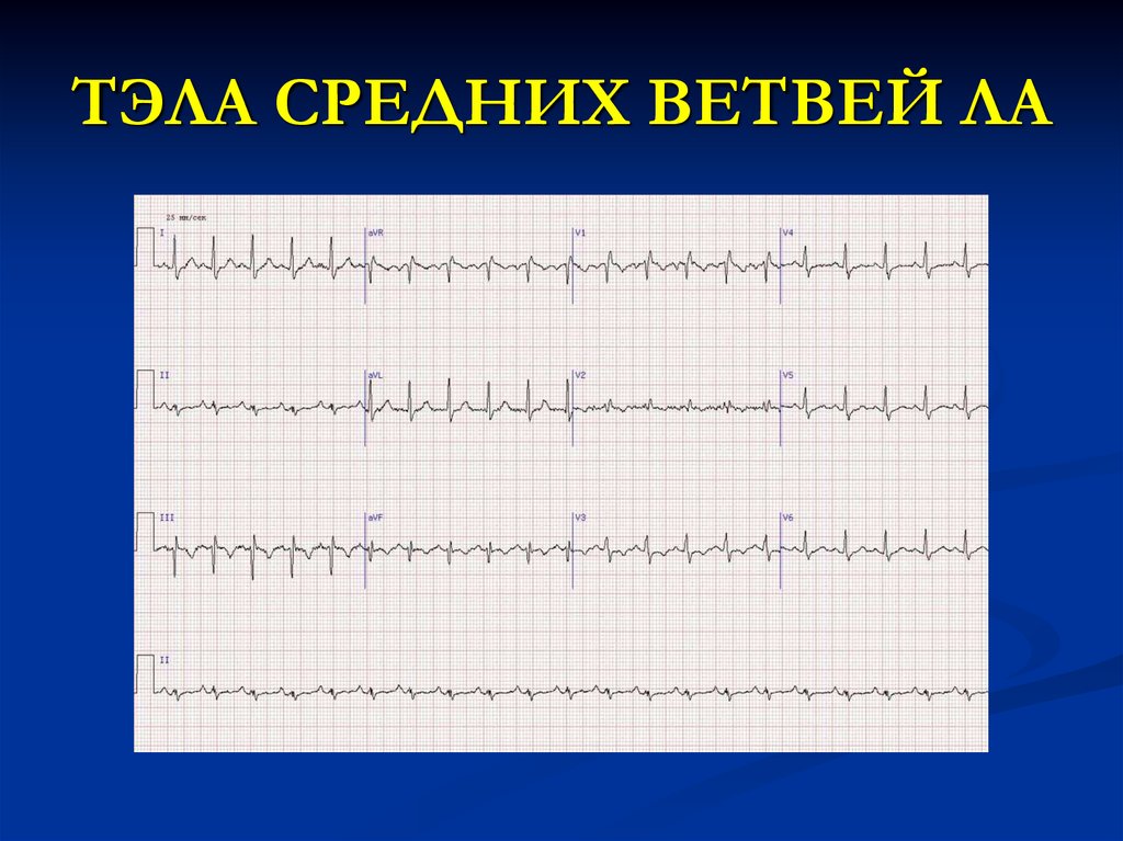 Экг при тэла картинки