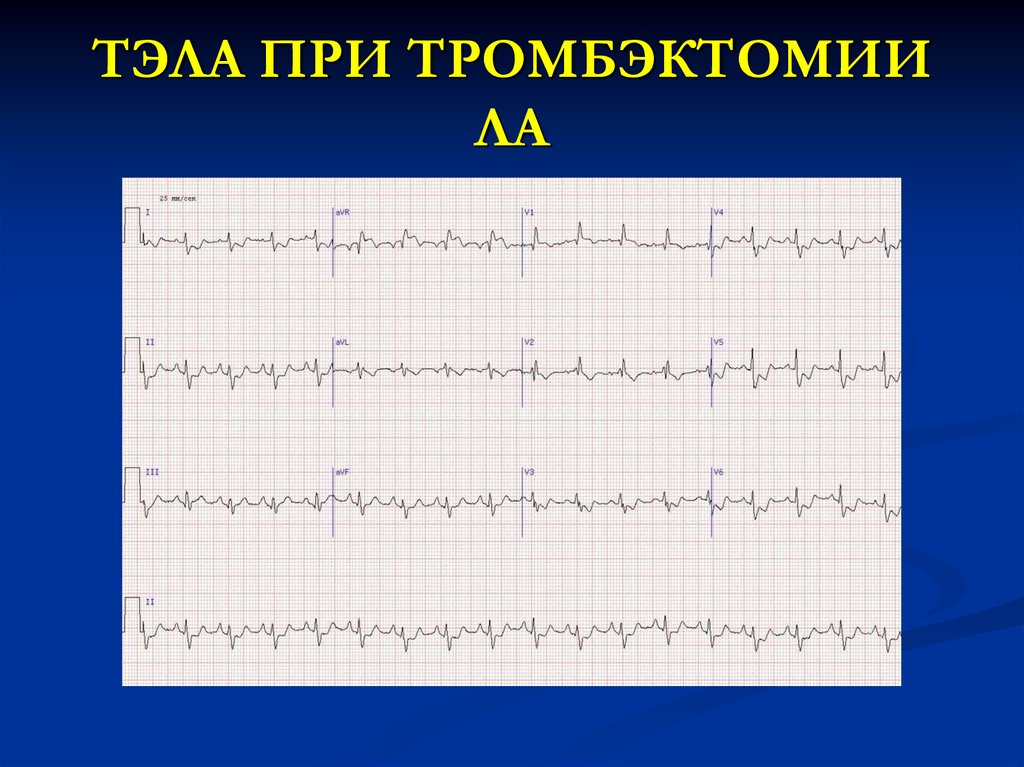 Рубцовые изменения нижней стенки на экг что это