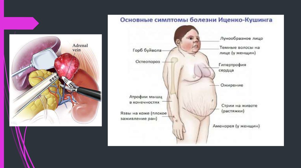 Болезнь у женщин симптомы. Синдром Иценко -Кушинга надпочечники. Надпочечная недостаточность симптомы. Гиперплазия надпочечников при болезни Иценко Кушинга. Болезни надпочечников у детей.