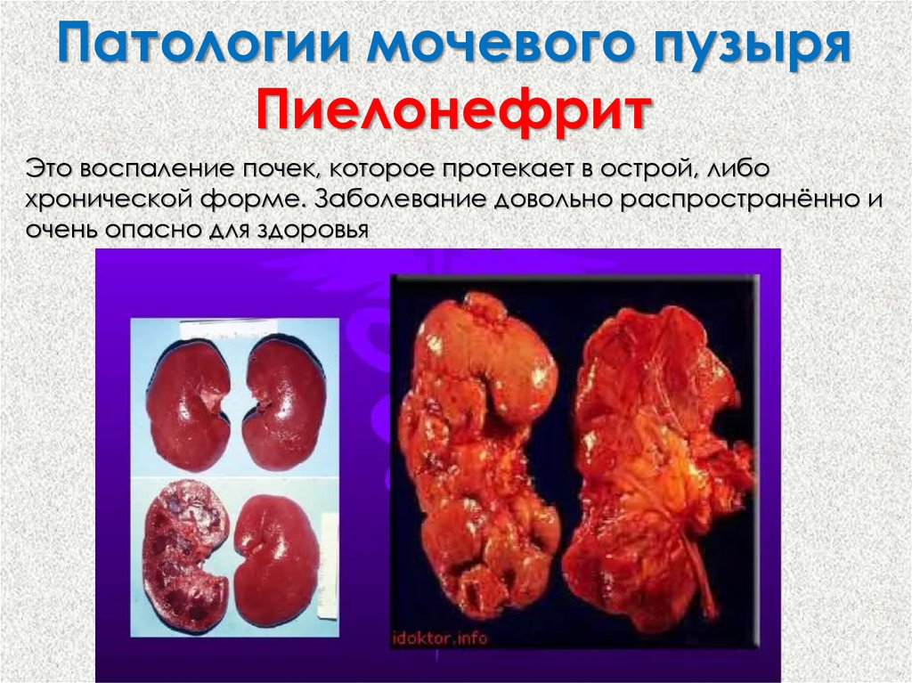 Патологии мочевого пузыря Пиелонефрит