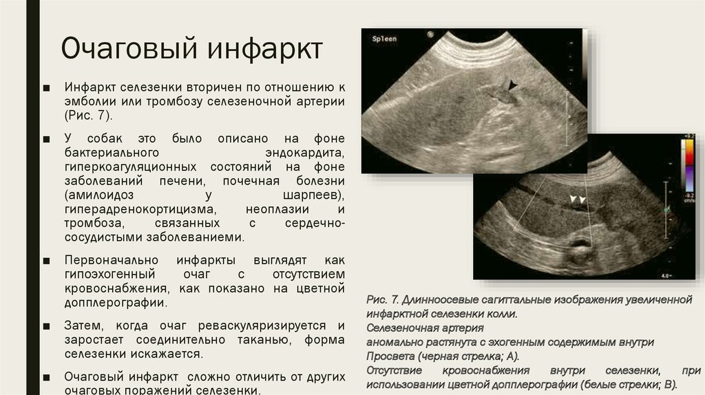 Распад селезенки. Зона инфаркта селезенки на УЗИ. Исход инфаркта селезенки УЗИ.