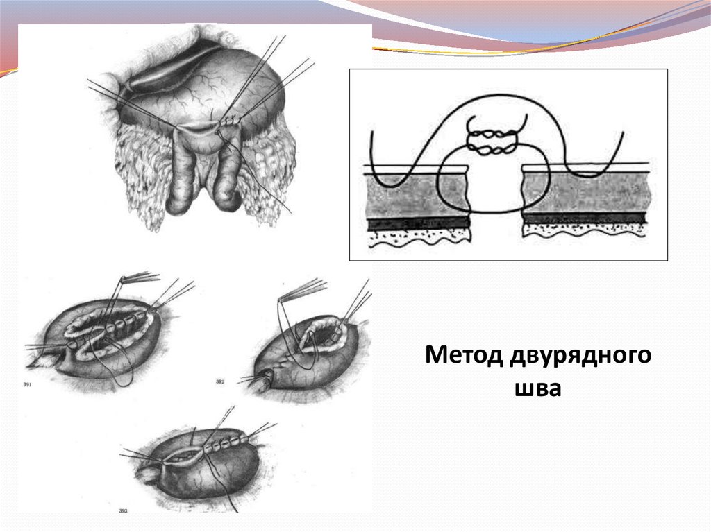 Наложение шва на матку. Перитонизация шва на матке.