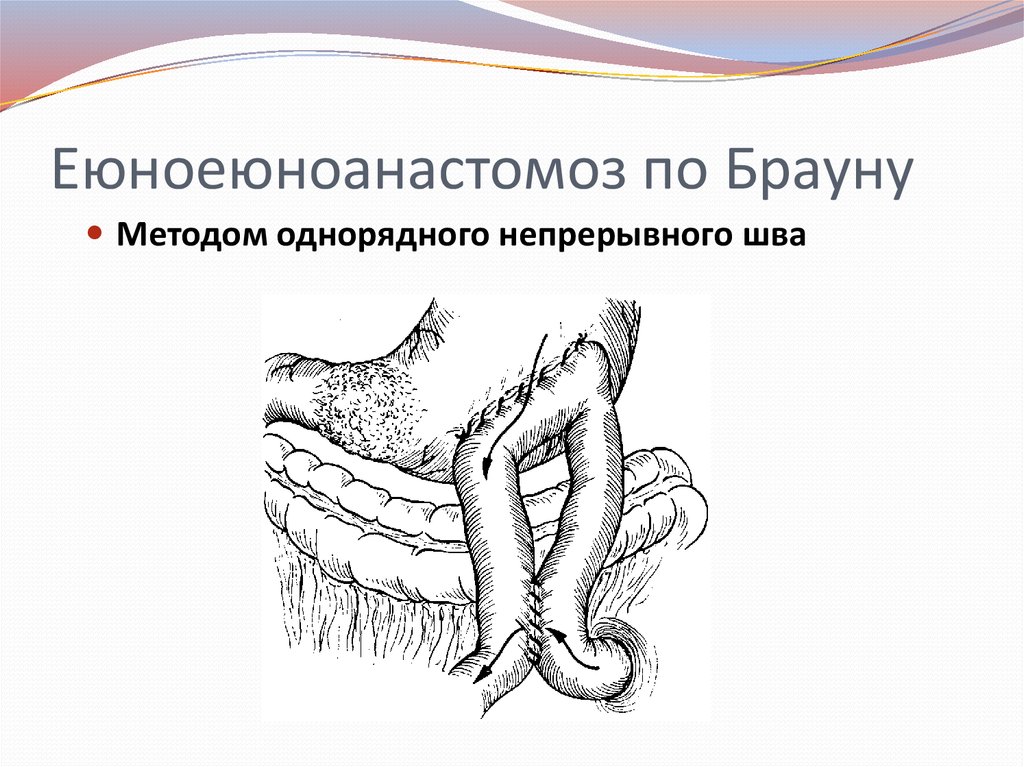 Еюноеюноанастомоз по Брауну