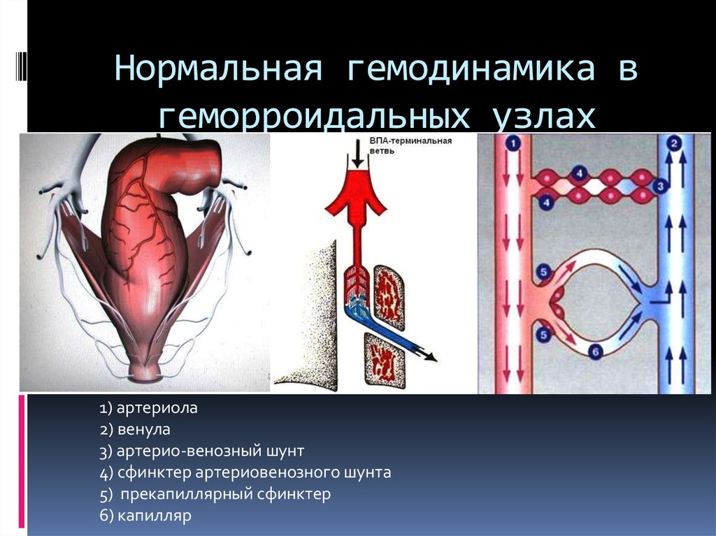 Малоинвазивное лечение геморроя. Геморроидальные венозные узлы. Механизм развития геморроя. Венозный узел геморрой. Гемодинамика геморроидальных узлов.