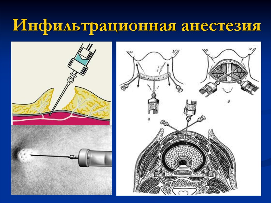 Местная анестезия схема