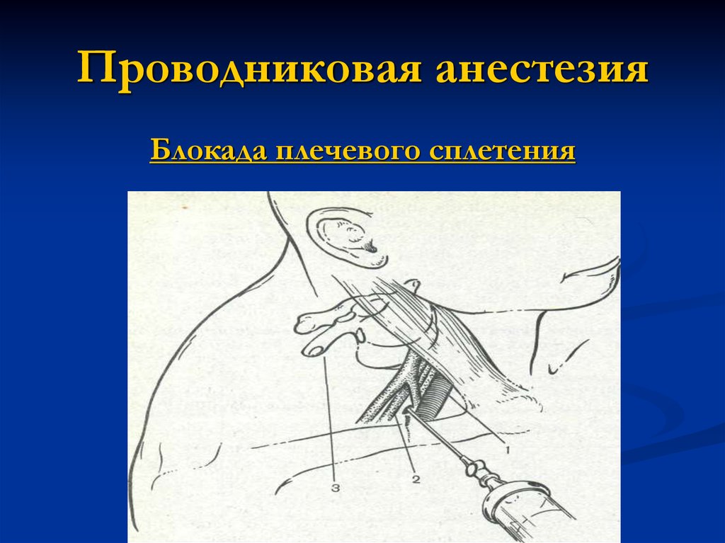 Для проводниковой анестезии применяют. Шейная блокада проводниковая анестезия. Паралюмбальная проводниковая анестезия. Проводниковая анестезия плечевого сплетения. Проводниковая анестезия по Оберсту-Лукашевичу.