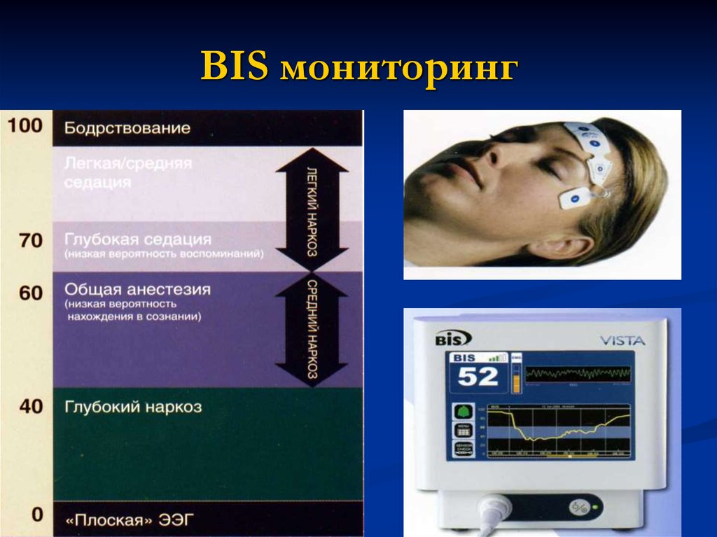 BIS мониторинг