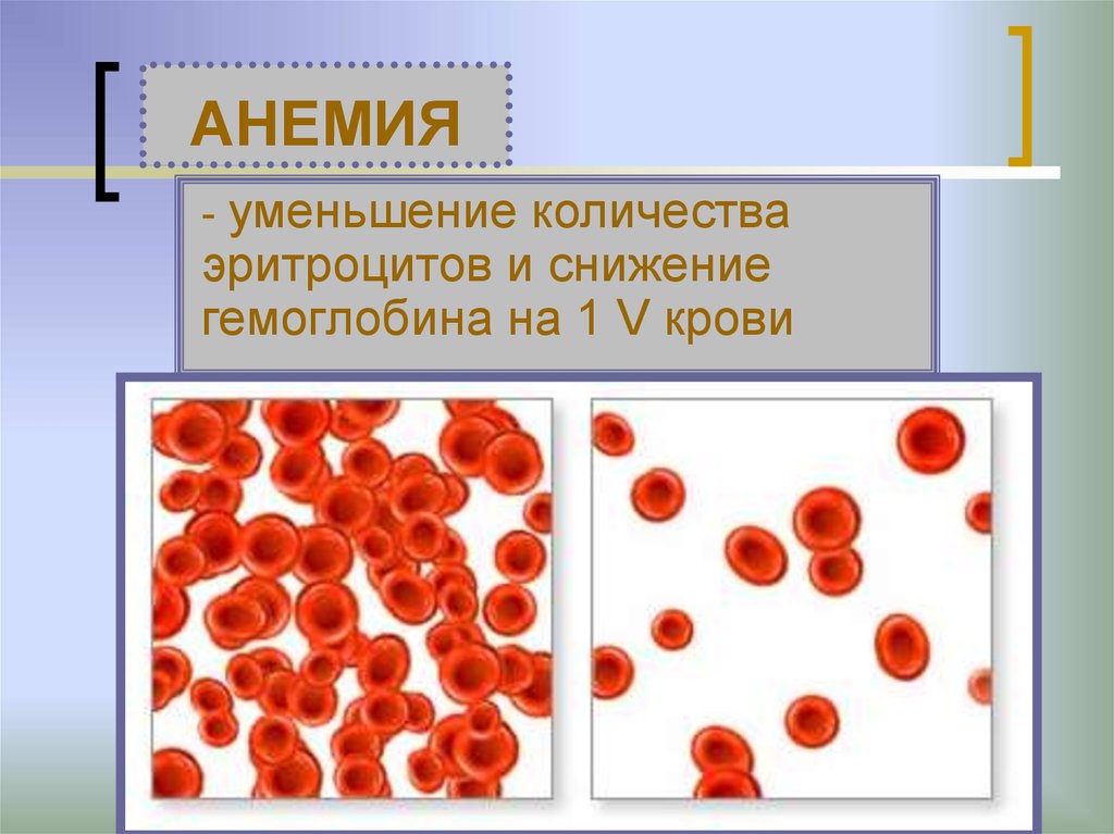 Анемия количество эритроцитов