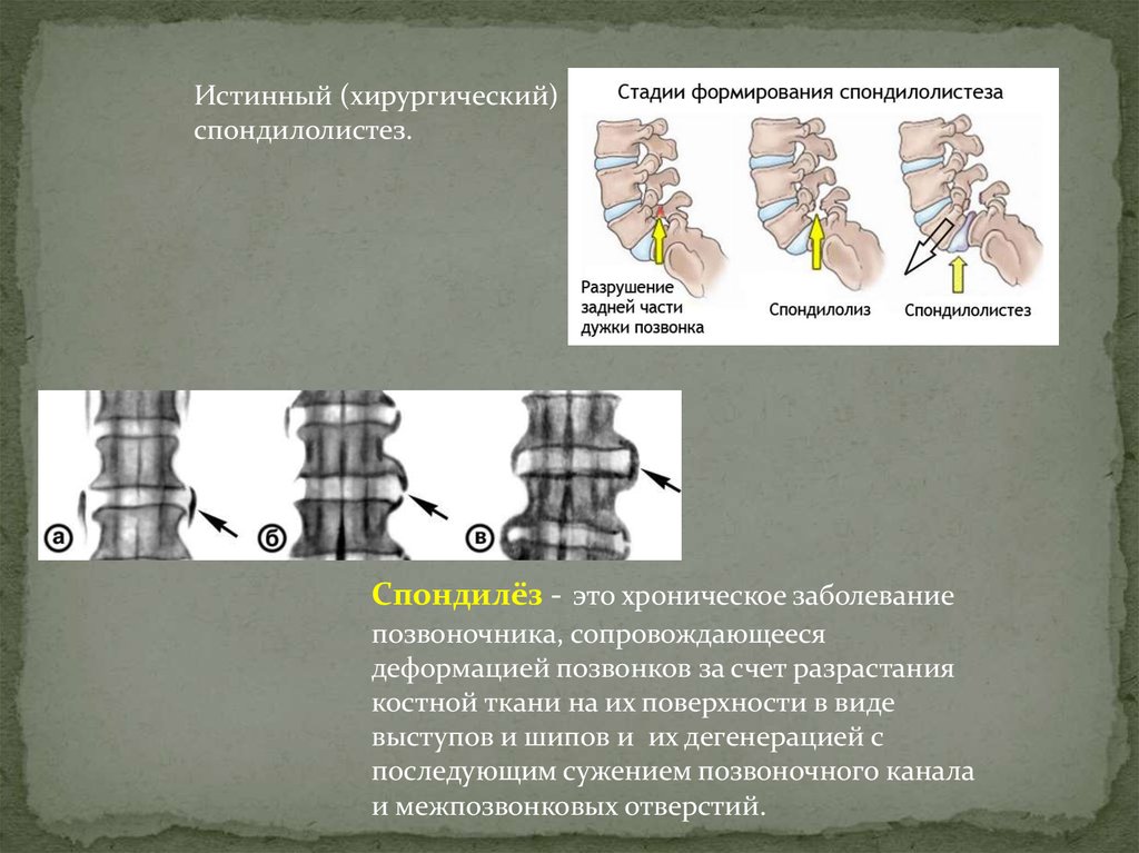 Деформирующий спондилез что это. Деформирующий спондилез l2 l5. Деформирующий спондилез, спондилоартроз рентген. Деформирующий спондилез l1-5. Спондилез l1-l5 что такое.