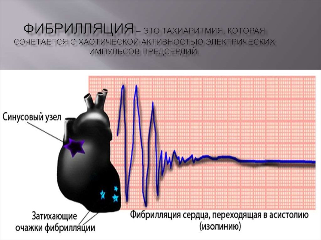 Фибрилляция предсердий презентация