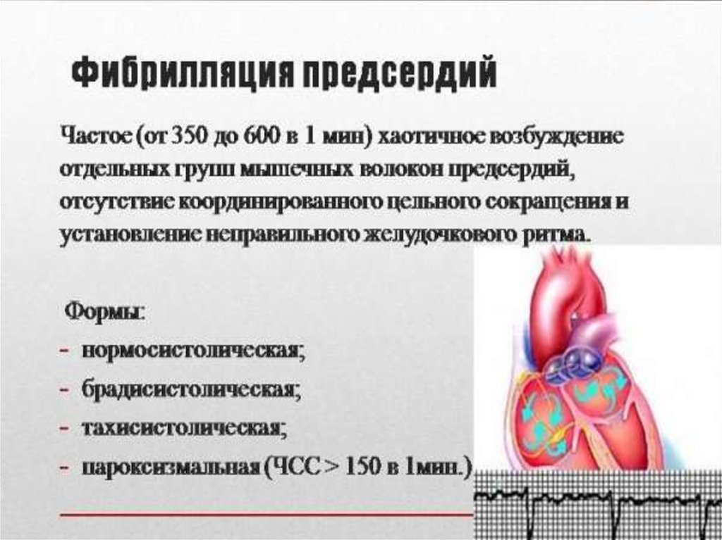 Фибрилляция предсердий презентация