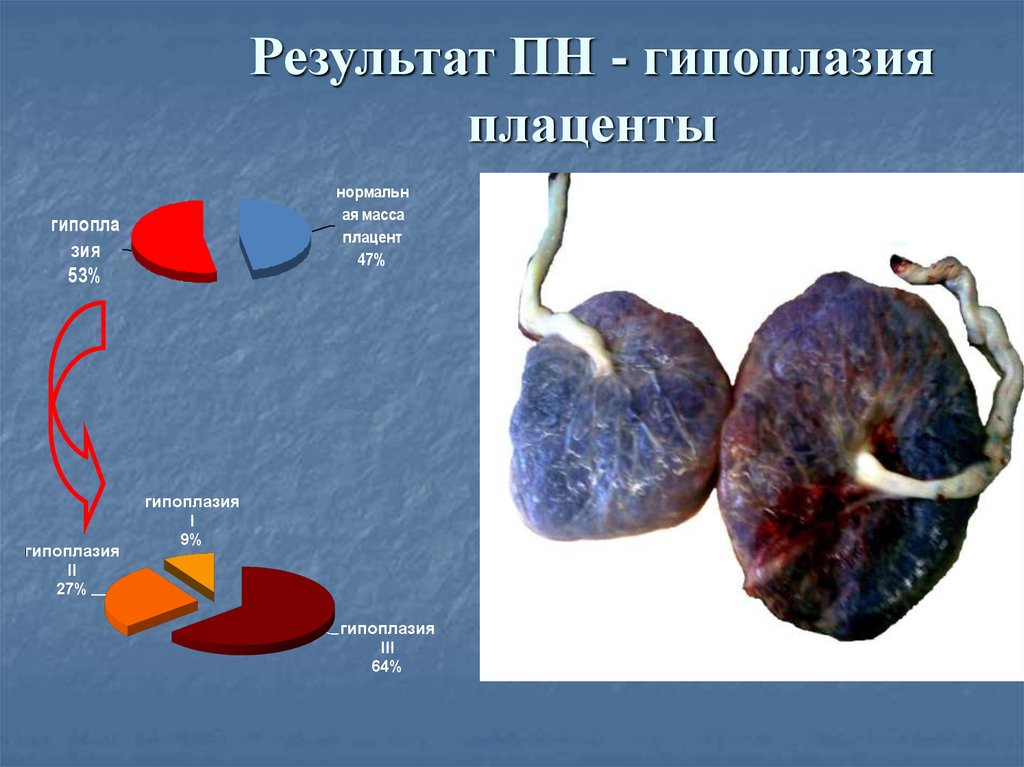 Результат ПН - гипоплазия плаценты