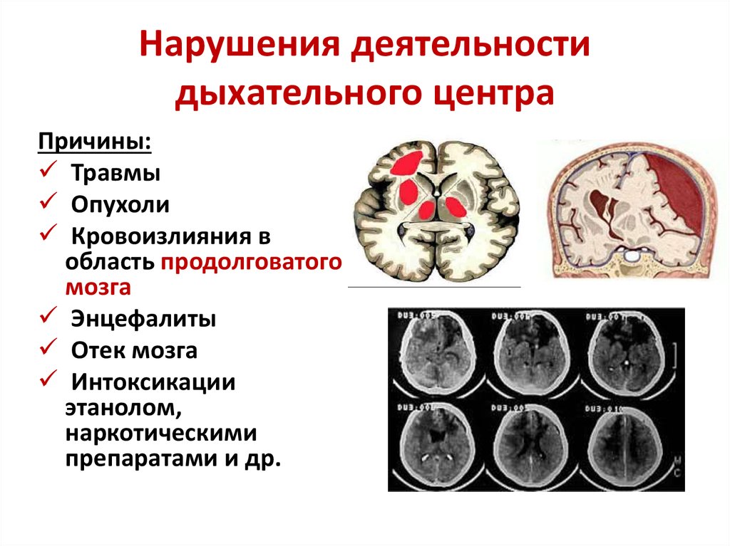 Причины нарушения дыхания. Нарушение дыхательного центра. Причины нарушения деятельности дыхательного центра. Поражение дыхательного центра. Анализ нарушения дыхания.