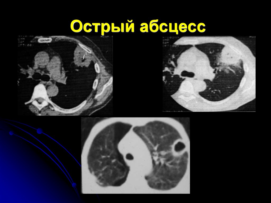Острый абсцесс