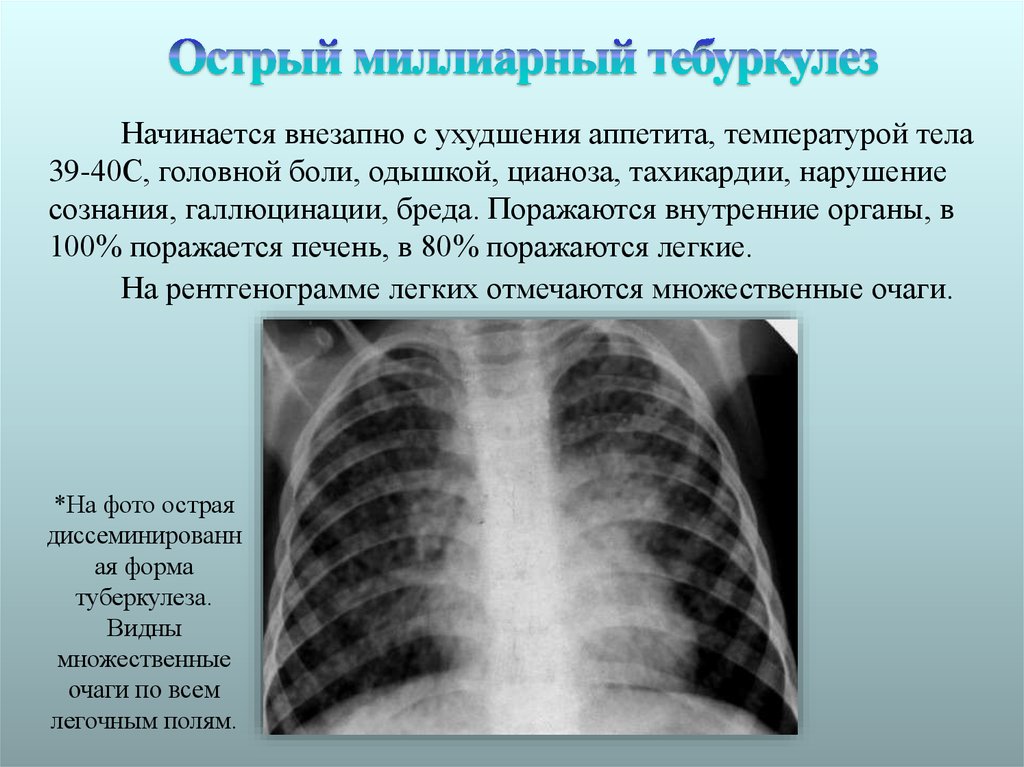 Формы диссеминированного туберкулеза. Рентген диссеминированного туберкулеза. Острый диссеминированный туберкулез рентген. Подострый диссеминированный туберкулез рентген. Лимфогенно диссеминированный туберкулез рентген.