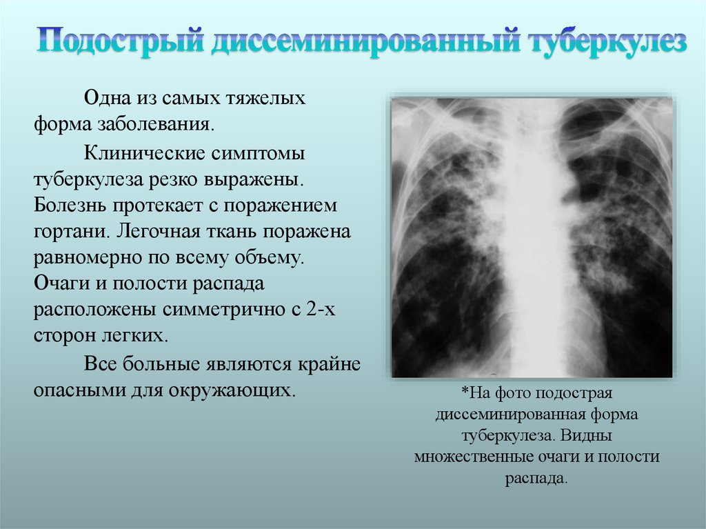 Формы диссеминированного туберкулеза. Подострый диссеминированный туберкулез рентген. Хронический диссеминированный туберкулез рентген. Диссеминированный туберкулёз лёгких подострый рентген. Подострый диссеминированный туберкулез легких симптомы.