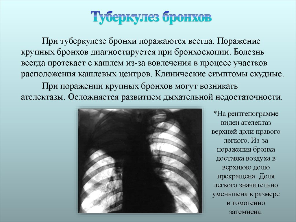 При туберкулезе чаще поражаются. Клинико-рентгенологические проявления туберкулеза бронхов. Туберкулез бронхов трахеи и верхних дыхательных путей рентген. Клинико рентгенологические признаки туберкулеза бронхов. Туберкулез бронхов рентген.