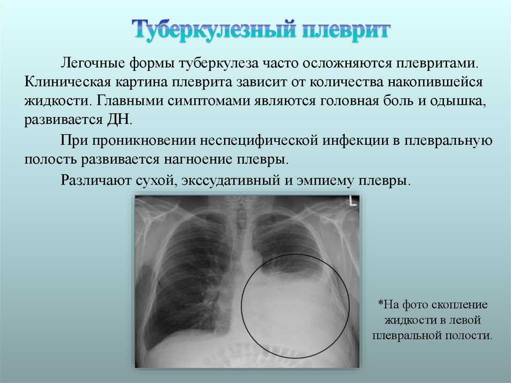 Клинический случай туберкулез. Экссудативный плеврит при туберкулезе рентген. Туберкулезный экссудативный плеврит. Экссудативный плеврит выпот. Туберкулёзный плеврит рентген диагноз.