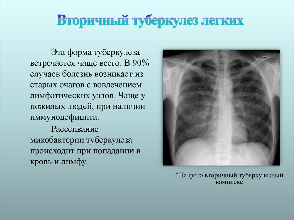 Как сделать туберкулез. Симптомы вторичного туберкулеза легких. Легкие формы туберкулеза. Вторичный туберкулез легких. Вторичный туберкулёз лёгких.