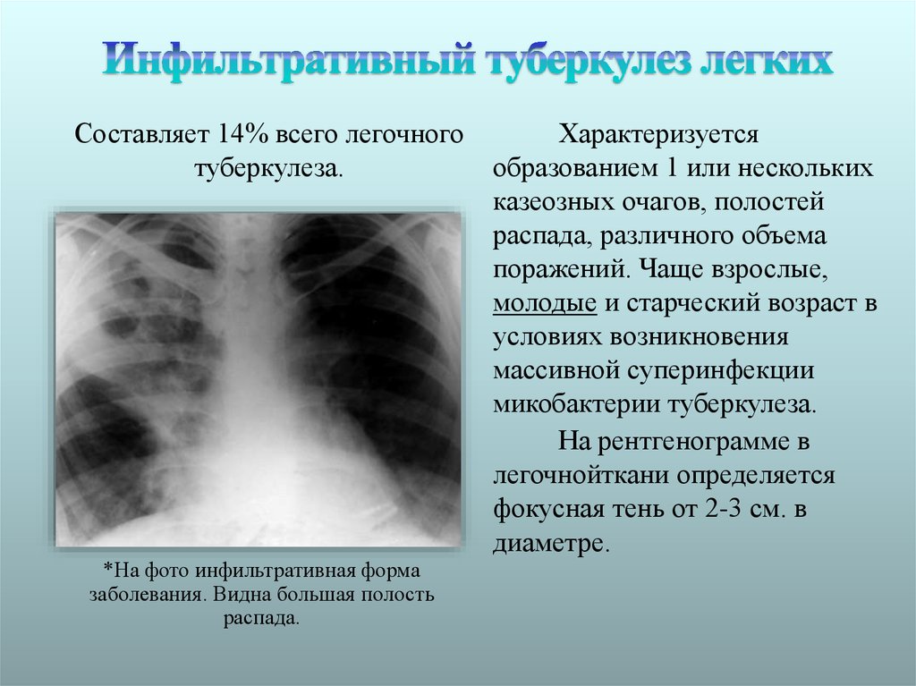 Полость заболевания легких. Клинические симптомы инфильтративного туберкулеза. Инфильтративный туберкулез с6. Полисегментарный инфильтративный туберкулез. Инфильтративный туберкулез синдромы рентген.