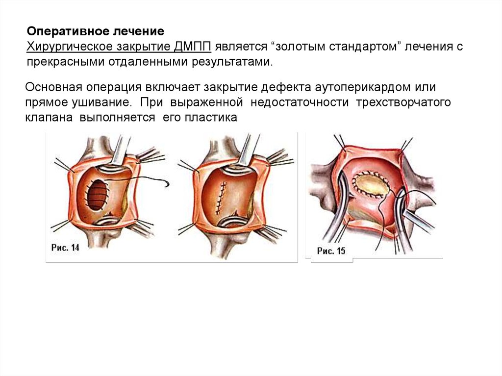 Недостаточность трехстворчатого клапана презентация