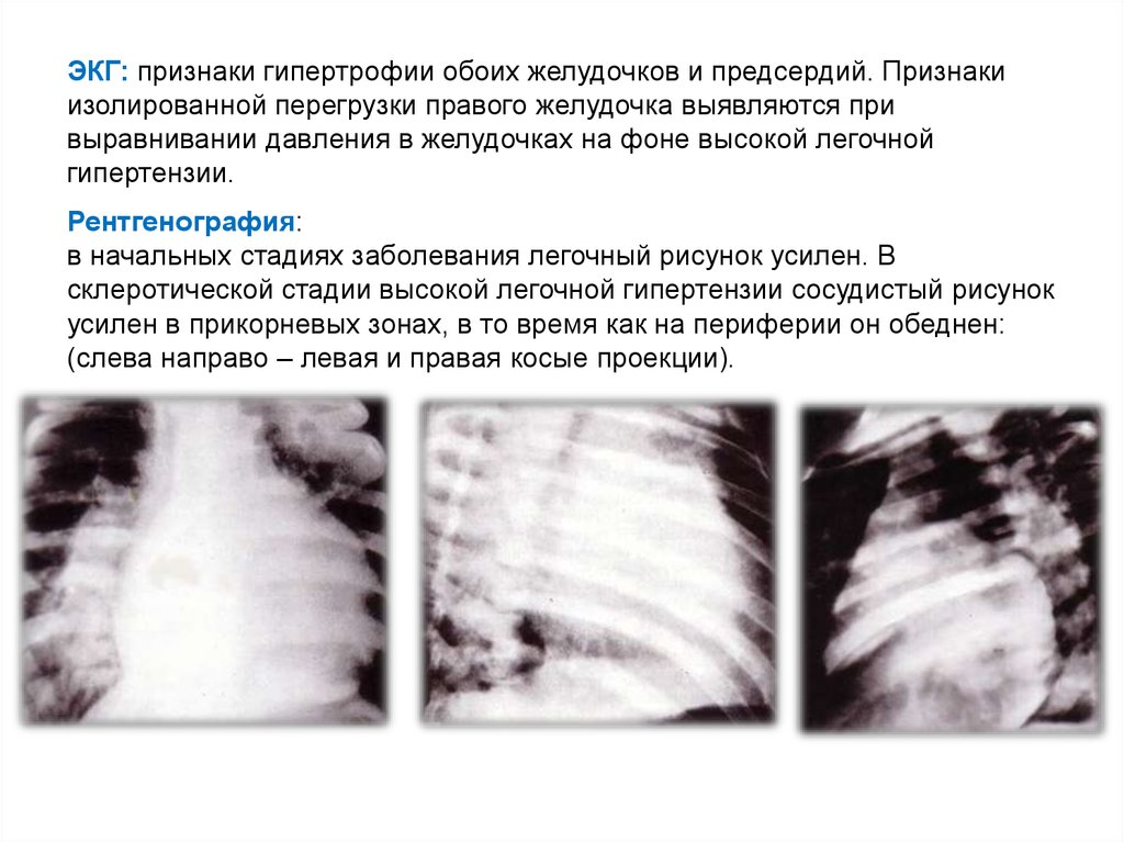 Усиление легочного рисунка в прикорневых зонах. Сосудистый рисунок незначительно усилен в прикорневых зонах что это. Обогащение легочного рисунка в прикорневой зоне. Умеренная прикорневая фиброзная деформация легочного рисунка.