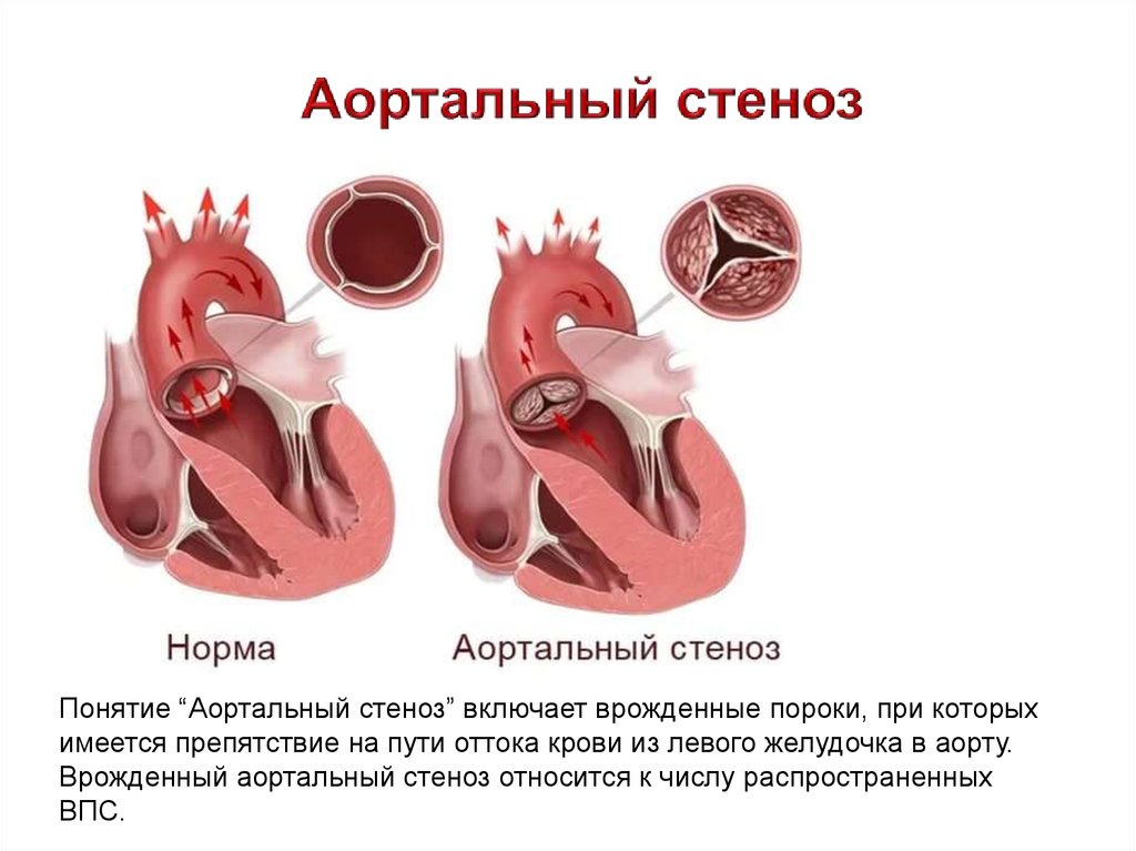 Что такое стеноз. Врожденные пороки сердца аортальный стеноз. Аортальный стеноз патофизиология. Врожденный аортальный стеноз характеризуется. Стеноз аортального клапана врожденный порок.